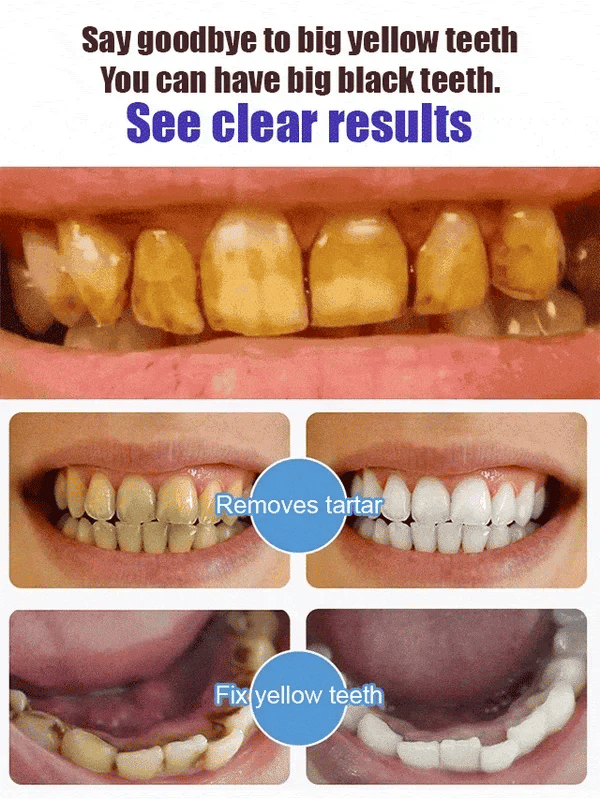 šŖ„Oveallgo⢠Aussie SP-6 Probiotic Ultra Whitening Toothpasteš¦·šØāāļøRecommendationš„75% OFF