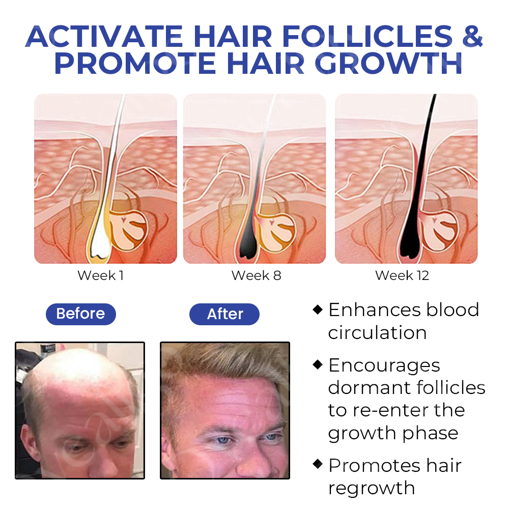 ✅Official Store: Oveallgo™ New BeeGrow Follicle Reviving Hair Essence 🌿 Endorsed by AAAF & TGA(Clinically proven to activate hair follicles, enhance scalp health, reduce inflammation, and prevent hair loss)