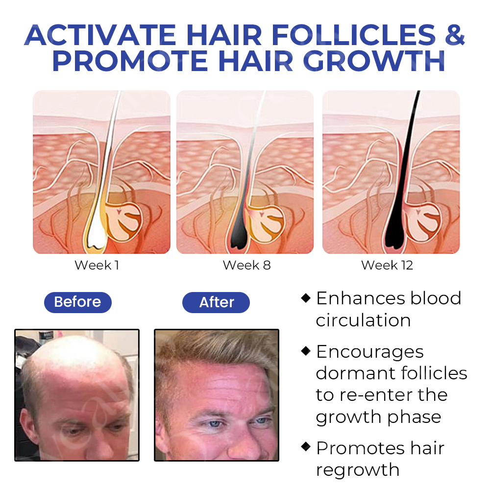 ✅Official Store: Oveallgo™ BeeGrow Follicle Reviving Hair Essence 🌿 Endorsed by AHLA & USP(Clinically proven to activate hair follicles, enhance scalp health, reduce inflammation, and prevent hair loss)